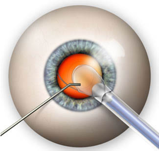 clear lens extraction surgery in delhi