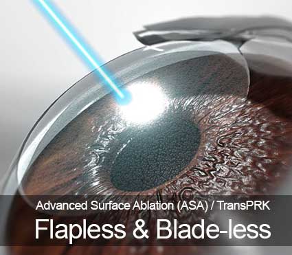 Advanced-Surface-Ablation-or-ASA-Eye-Laser-Surgery