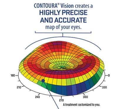 Contoura Vision Cost in Delhi