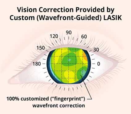 Customized-Lasik-vs-Standard-Lasik in Delhi