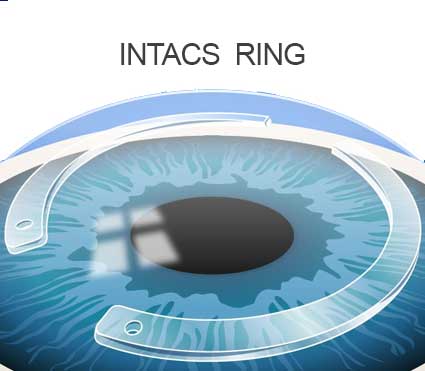 Keratoconus Treatment (C3R & INTACS)