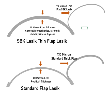 SBK thin flap Lasik vs Standard Lasik in delhi