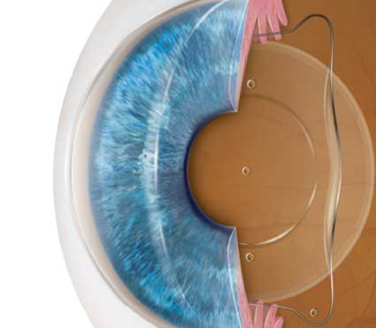 Implantable Contact Lens (ICL) Surgery in Delhi