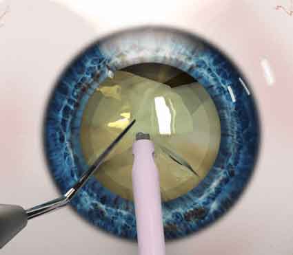 Cataract Surgery in Delhi